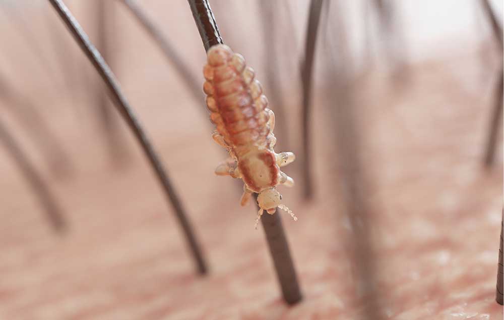 Eine Laus am Haar Es ist ein Kopf in Nahaufnahme zu sehen wie eine Kopflaus an eine Haar hängt.